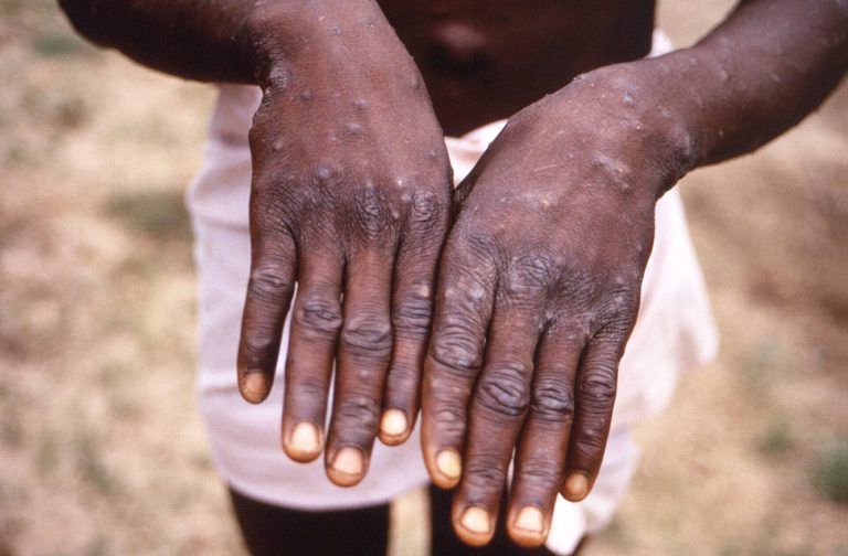 Kenya reports its first Mpox death as confirmed cases increase to 13.